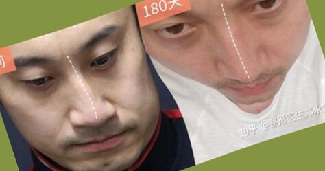 面相 鼻子歪